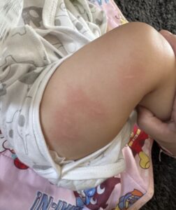 2026.6.13 生後8ヶ月、蕁麻疹