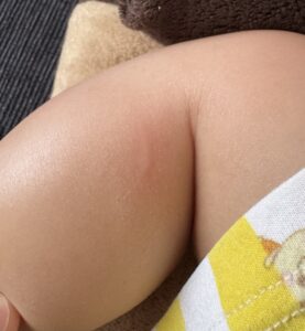 2026.6.12 生後8ヶ月、蕁麻疹