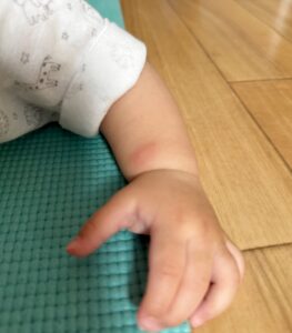 2026.7.1 生後8ヶ月、蕁麻疹