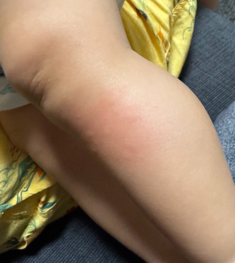 赤ちゃんの蕁麻疹の実際の写真。くっきりした楕円形の赤い膨らみ