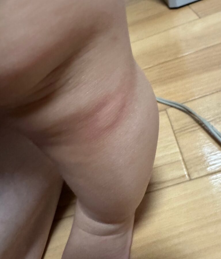 赤ちゃんの蕁麻疹の実際の写真。太ももにできた大きめの腫れ