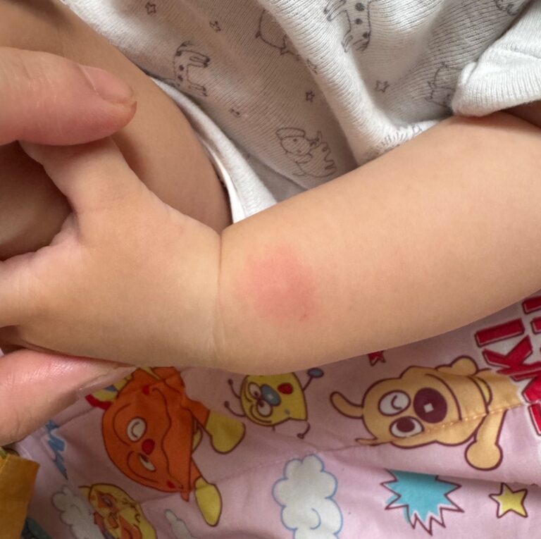 赤ちゃんの蕁麻疹の実際の写真。腕（手首の上）にできた赤い膨らみ